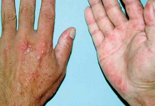 Como sanar las uñas en los pies del hongo inveterado